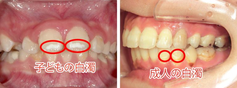 気になる歯の白濁、その正体は？
